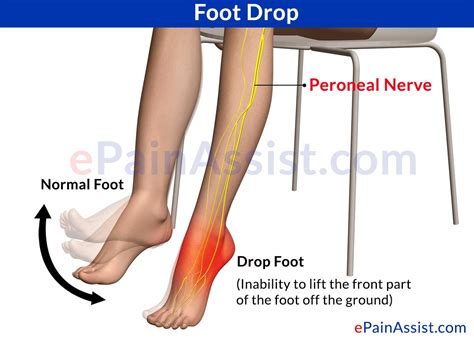 what is foot drop treatment